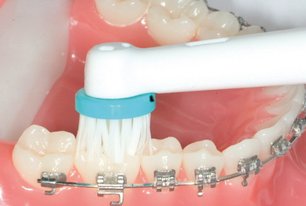 Die Kauflächen der Zähne putzen. Brackets: Zahnpflege bei festsitzenden Zahnspangen